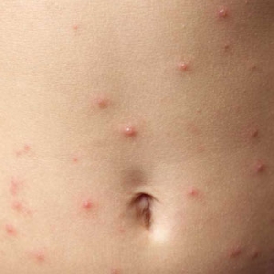 Allergies: Symptoms, Causes And Treatment