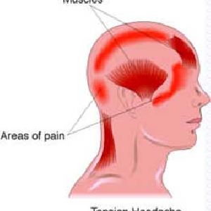 Tension Headaches
