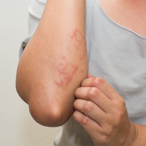 How To Relieve Itchy Skin?