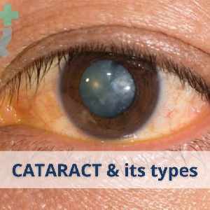 All You Need To Know About Cataract